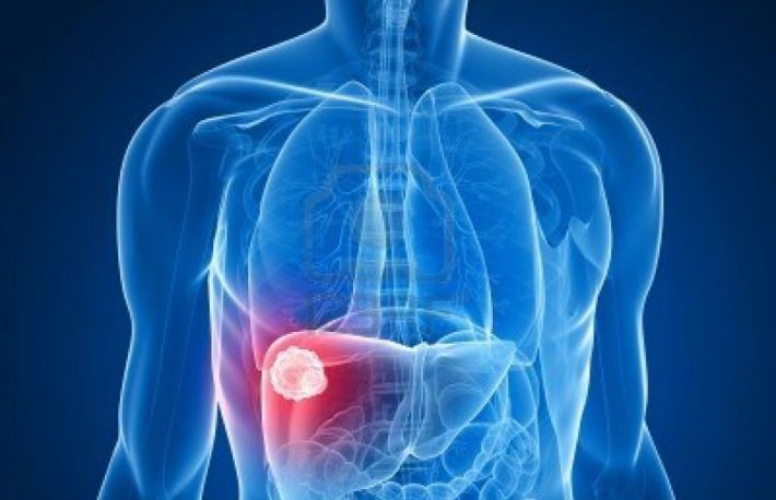 Simptomele cancerului de ficat