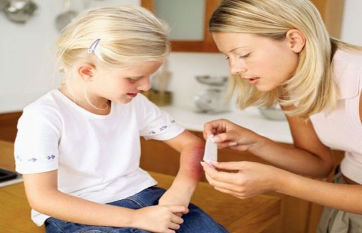 Lectii de prim ajutor: Cum sa tratezi rapid arsurile?