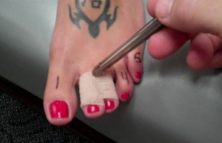 Cum se trateaza degetele luxate?