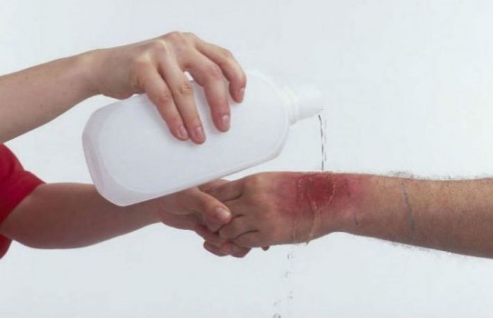Remedii homemade pentru arsuri