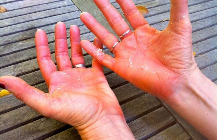 Psoriazis. Care sunt cele mai frecvente simptome?