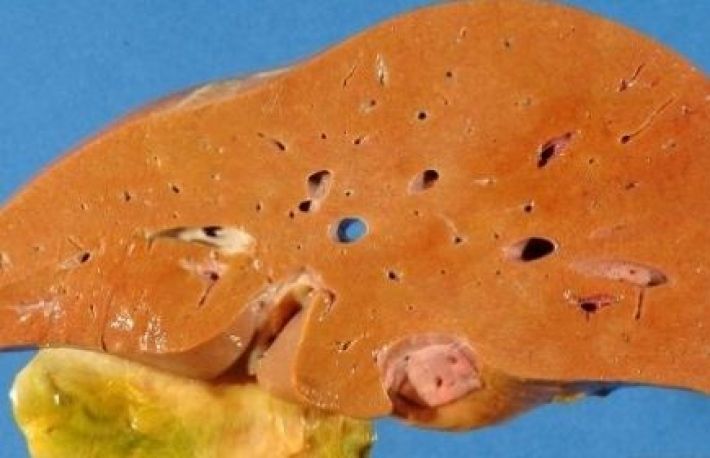 Cum sa recunosti FICATUL GRAS - STEATOZA HEPATICA