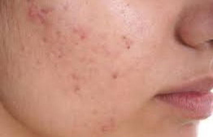 Ce alimente trebuie sa eviti daca ai acnee