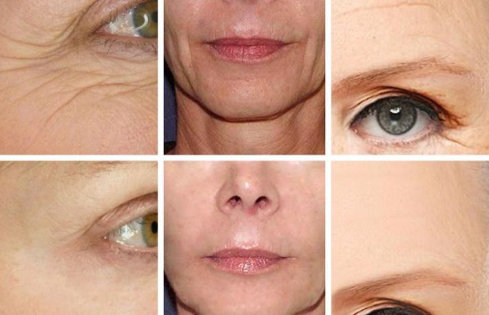 Cum sa combati ridurile. Foloseste aceste substante