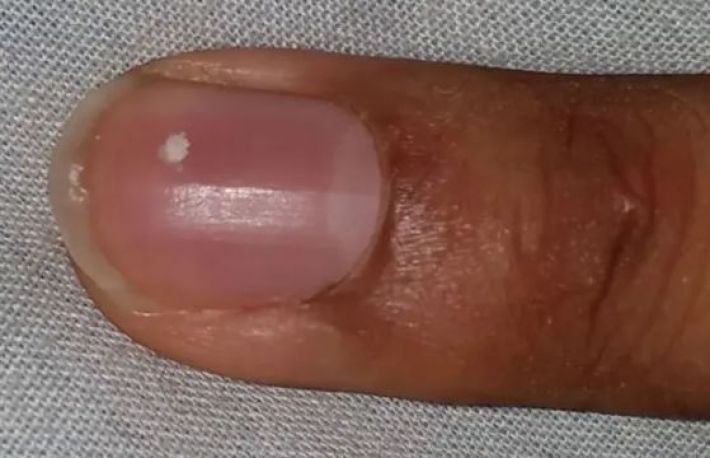 Cum si de ce apar petele albe sub unghii