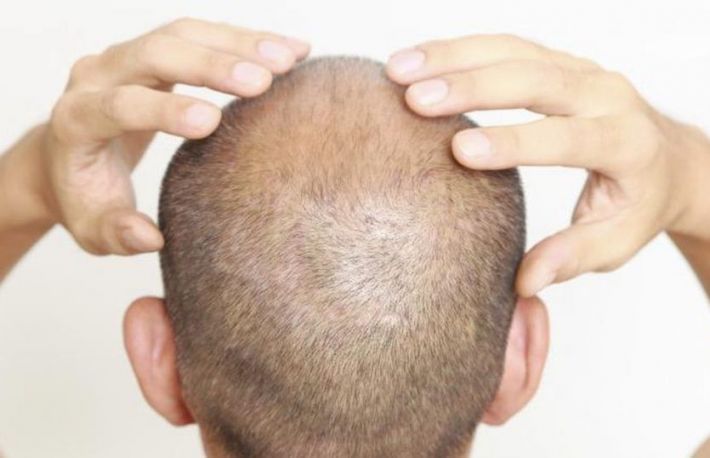 Calcinoza cutanata. Cum sa elimini depunerile de calciu de la nivelul scalpului