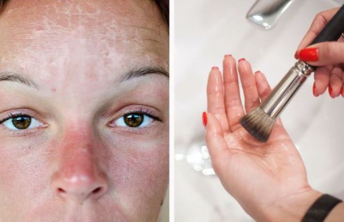 Ai suferit arsuri solare? Iata ce nu trebuie sa faci in aceasta situatie