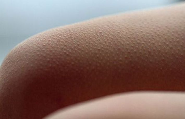 Ce cauzeaza pielea de gaina/keratoza pilara si cum sa scapi de ea