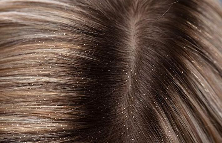 Cum sa scapi de matreata. 10 metode naturale