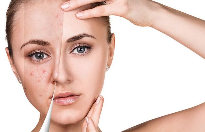 Cum sa obtii un ten de invidiat. Solutie ieftina si naturala