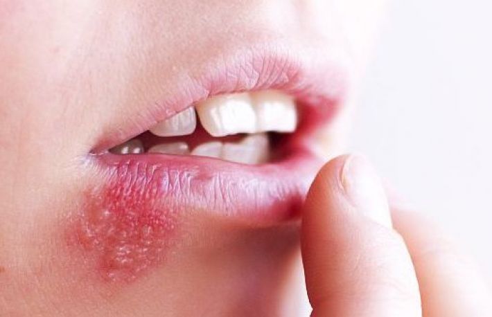 Cum sa stopezi eruptia de herpes