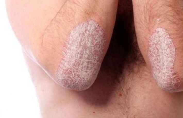 Cum sa tratezi psoriazisul. 3 metode naturale