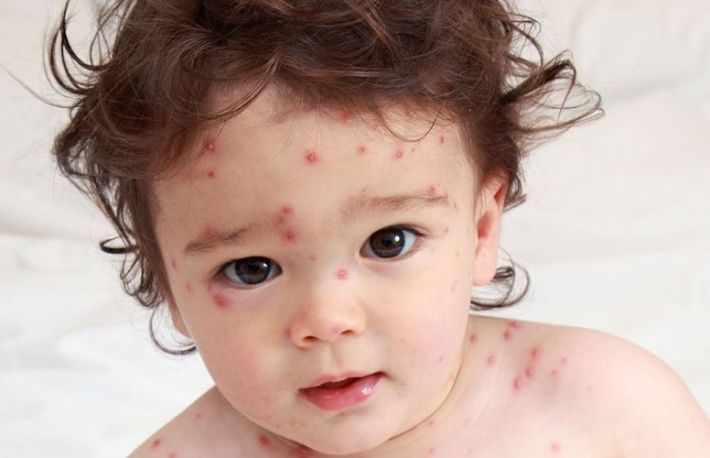 Cum sa recunosti si sa tratezi varicela
