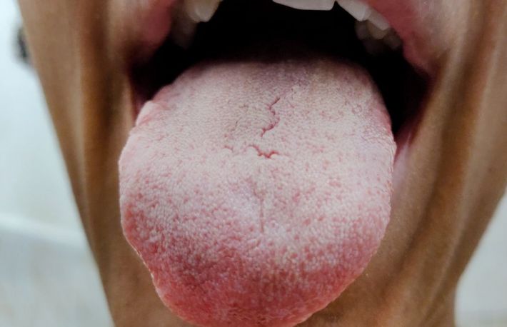 Cum sa tratezi limba alba/saburala