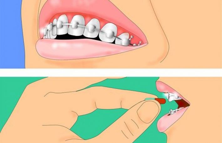 Cum se curata un aparat dentar?