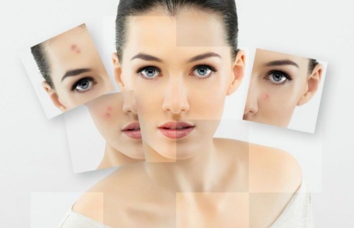 Cum sa scapi rapid de cosuri?