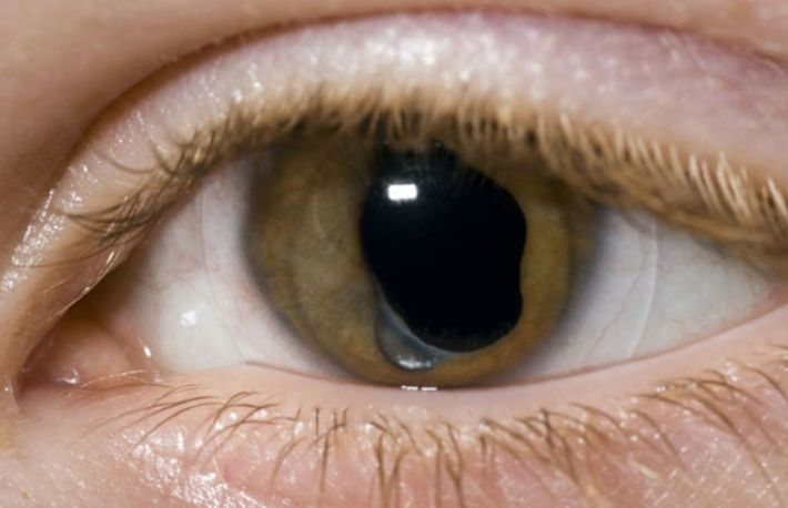 Cum se poate depista cataracta? Simptome