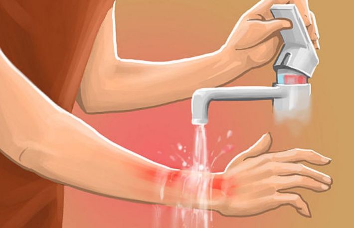 Cum se trateaza arsurile?