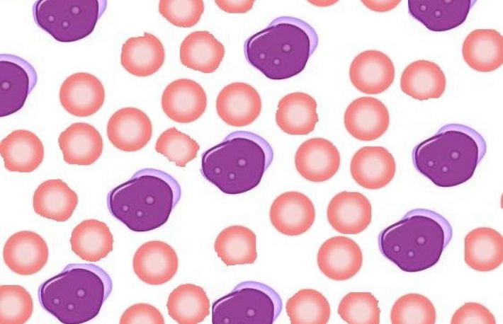 Afla cum se diagnosticheaza leucemia?