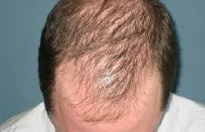 Prevenirea pierderii parului