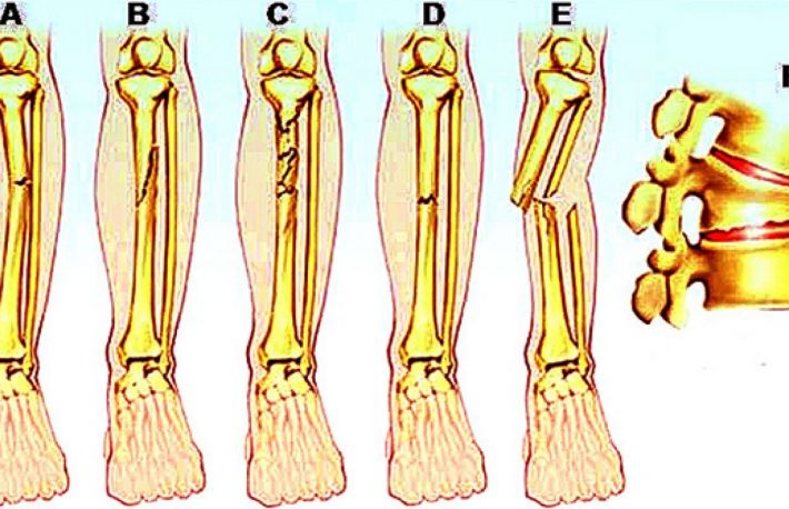 Metode de prim ajutor in cazul fracturilor de oase