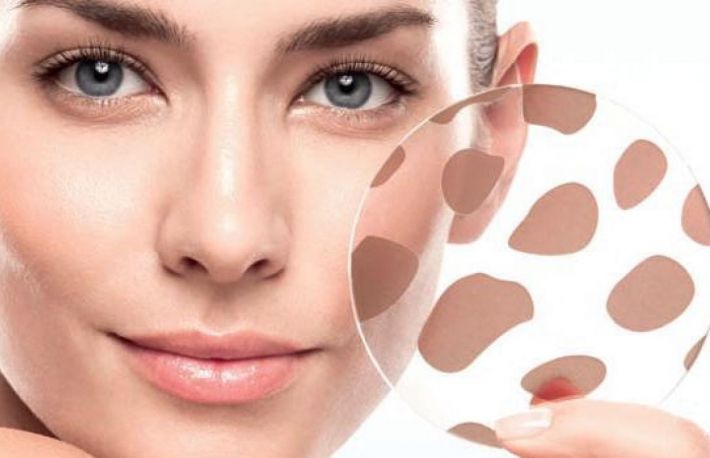 De ce apar petele pe piele?