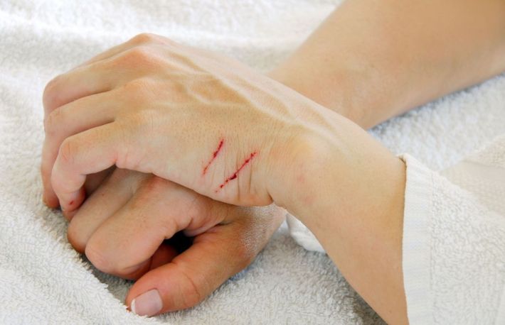 Cum se trateaza taieturile si zgarieturile superficiale