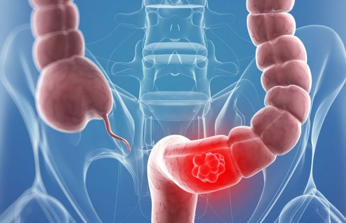 Care sunt simptomele cancerului de colon