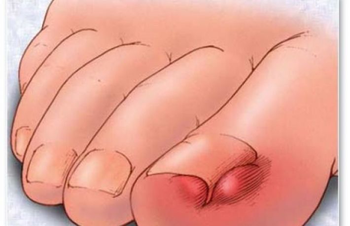 Cum sa scapi de unghiile incarnate