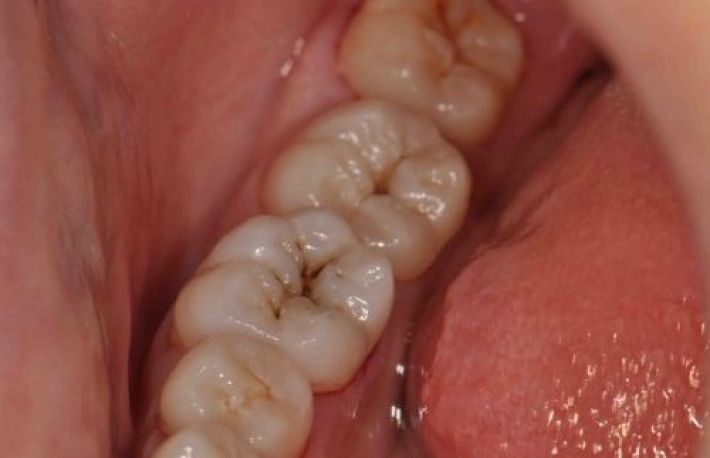 Cum sa scapi de CARII fara sa mergi la stomatolog