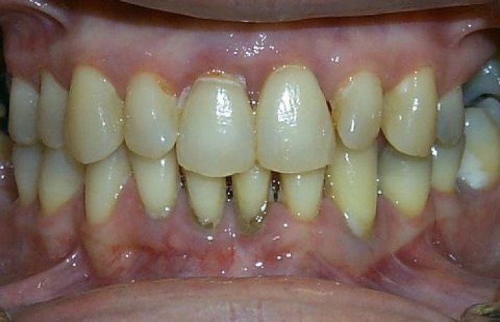 Cum sa previi PARODONTITA. Consuma aceste produse