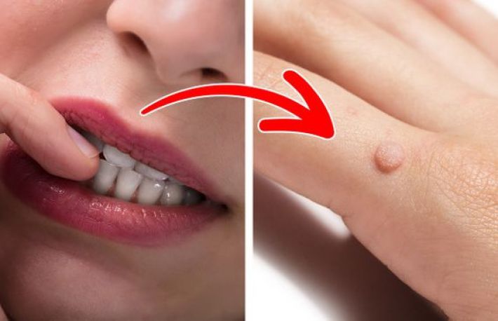 Cum sa previi aparitia negilor