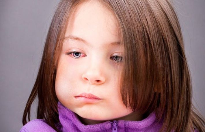 Oreion - cauze, simptome, tratament