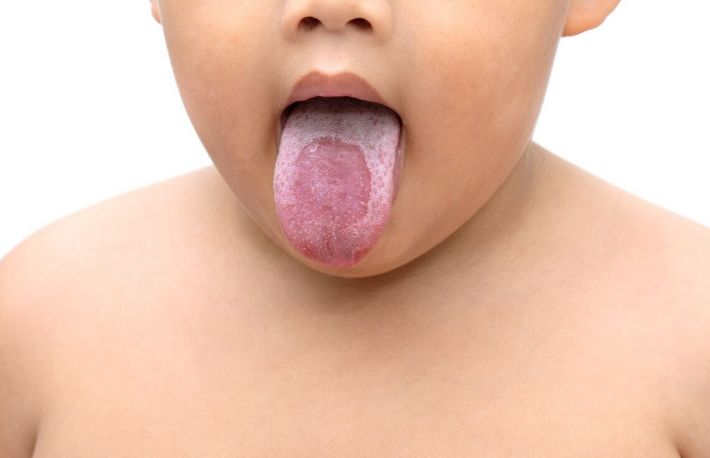 Bebelusi. Cum sa tratezi candidoza bucala