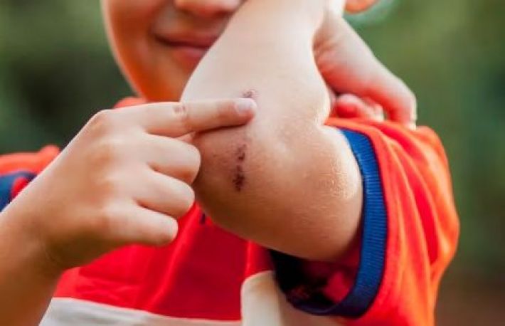 Cum sa ingrijesti o rana. Nu rupe crusta!