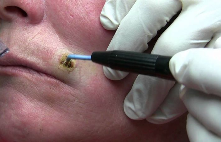 Cum sa indepartezi alunitele. Cele mai comune metode