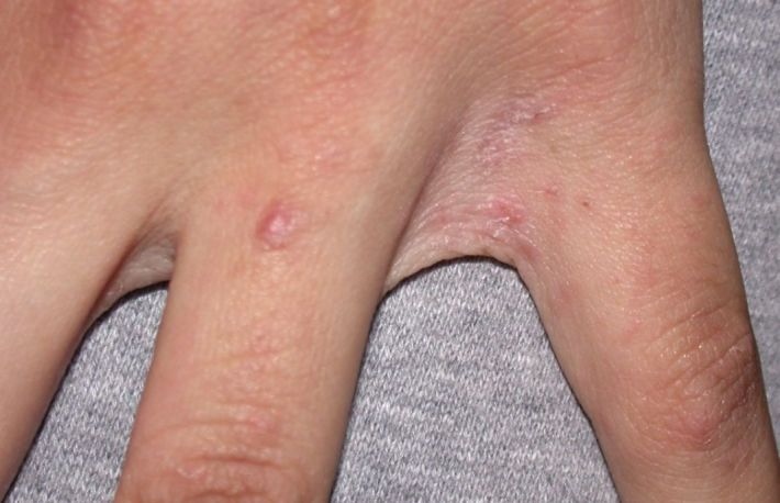 Cum se trateaza scabia?