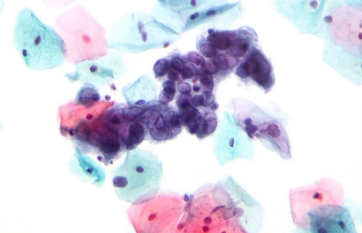 Cum se trateaza herpesul genital?