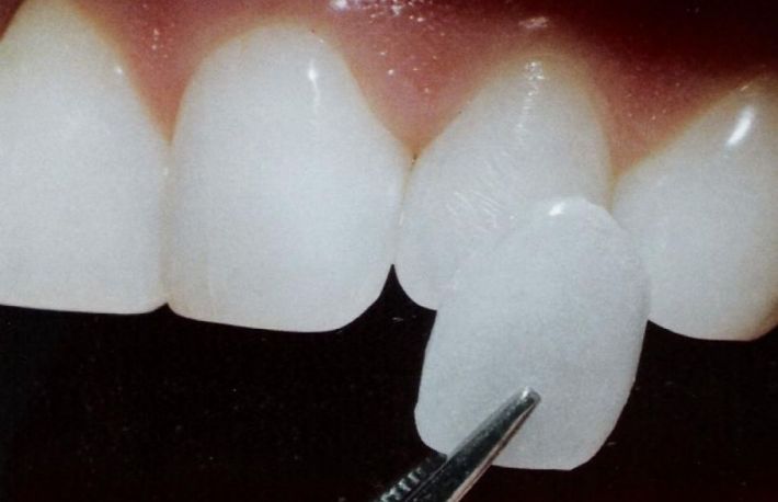 Cum se produc fatetele dentare?